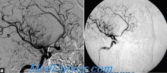 интраоперационный разрыв аневризмы мозга