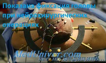 разрыв аневризмы сосуда головного мозга