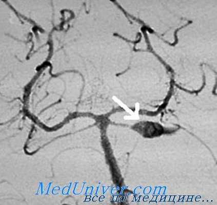 разрыв аневризмы сосудов головного мозга