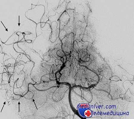 интраоперационный разрыв аневризмы мозга