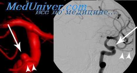 разрыв аневризмы сосудов головного мозга