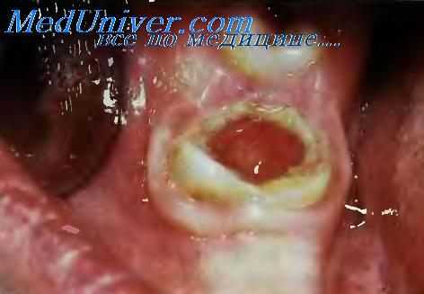 диагностика кариеса