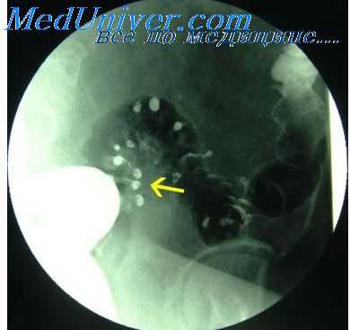 кишечный свищ