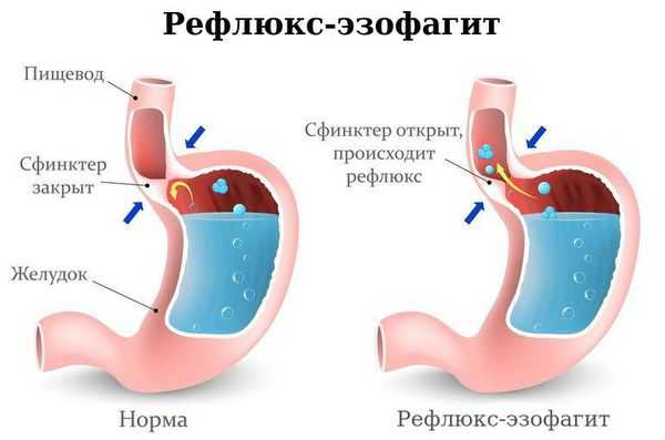 Рефлюкс-эзофагит