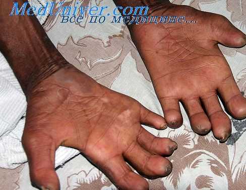 лечение лепры