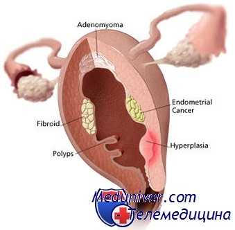 дисфункциональные маточные кровотечения