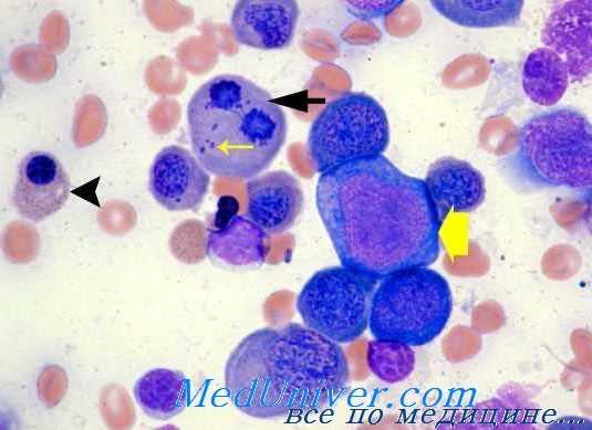 мазок при мегалобластной анемии