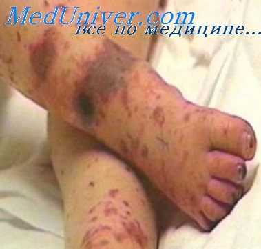 менингококковая инфекция