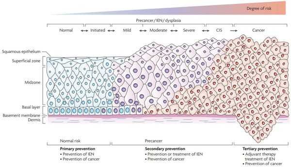 дисплазия шейки матки