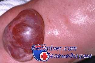 миеломенингоцеле