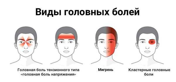Локализация различных видов головной боли 
