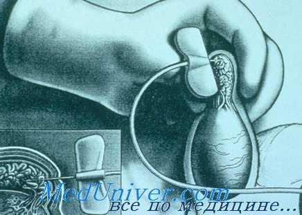 биопсия яичка