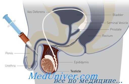 биопсия яичка