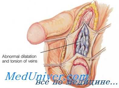 лечение мужского бесплодия