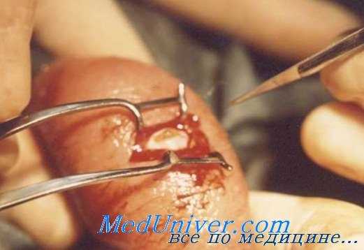 лечение мужского бесплодия