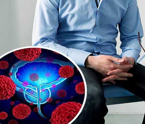 Основные факторы мужского бесплодия