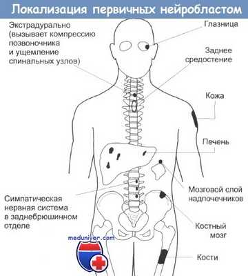 Локализация первичных нейробластом