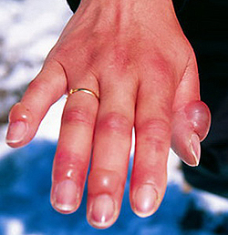 Отморожение 2 степени