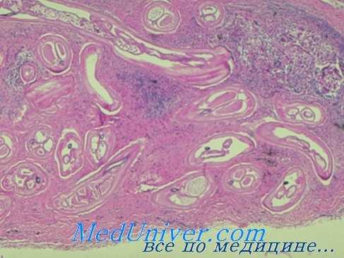 диагностика онхоцеркоза