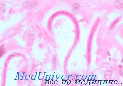 дитразин при онхоцеркозе