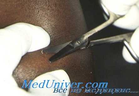 диагностика онхоцеркоза