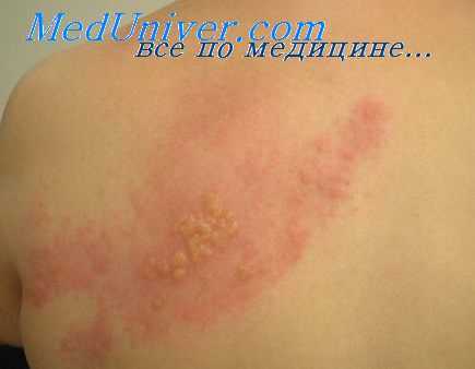 опоясывающий лишай