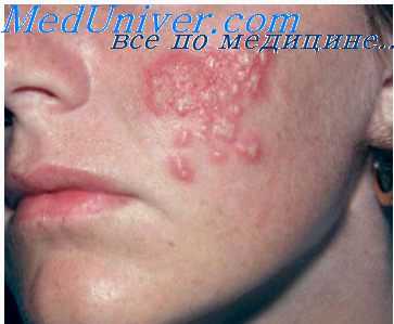 простой герпес