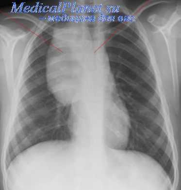 тератома средостения