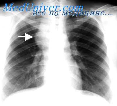 опухоли средостения