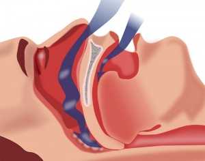 При апноэ сна возникает сужение и периодическое спадение стенок глотки, что проявляется остановками дыхания во сне на фоне храпа