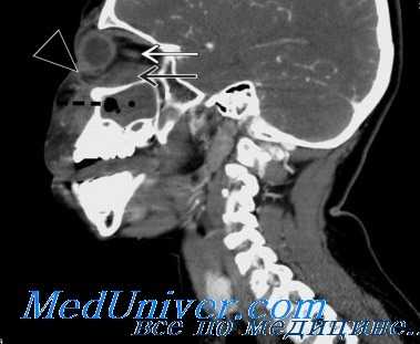 осложнения орбитотомии