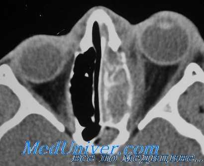 эндокринная офтальмопатия