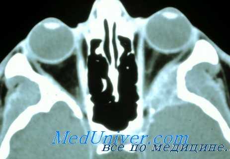 остеомиелит орбиты глаза