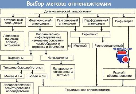 Выбор метода операции при аппендиците - аппендэктомии