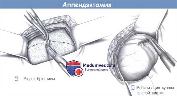 Этапы и техника операции при аппендиците - аппендэктомии