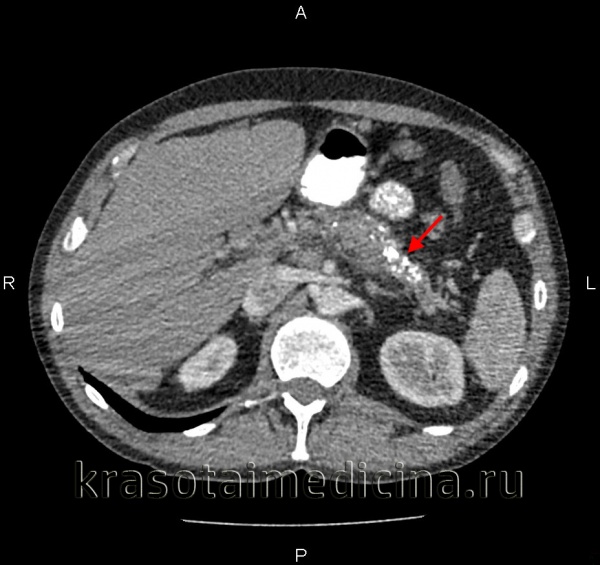 Острый панкреатит