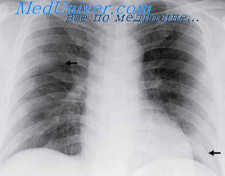 респираторный синдром