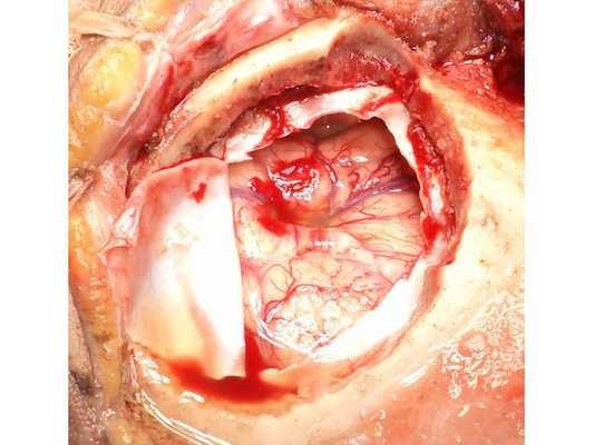 Интраоперационная фотография, выполненная после аспирации гнойного содержимого из полости абсцесса и промывания полости антисептическими растворами
