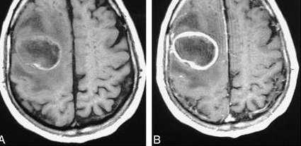 ЭКСТРАДУРАЛЬНЫЙ ОТОГЕННЫЙ АБСЦЕСС.jpg