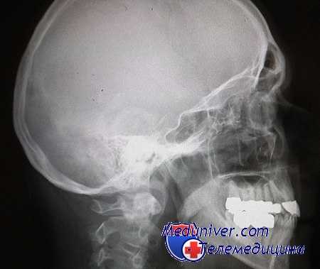 отогенный менингит