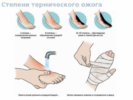 Оказание первой помощи при ожогах