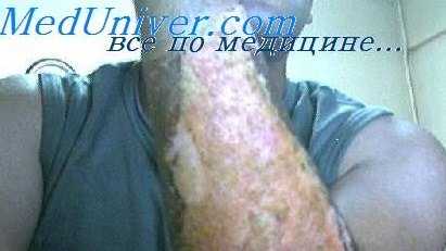 лечение ожогового шока