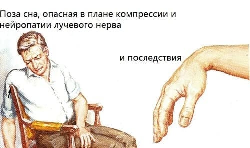Сонный паралич лучевого нерва