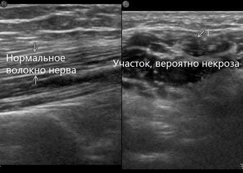 УЗИ периферических нервных волокон