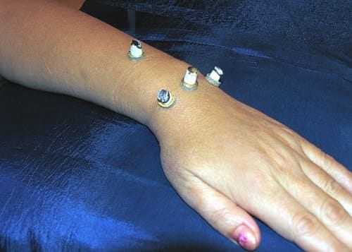 Прижигания при нейропатии лучевого нерва