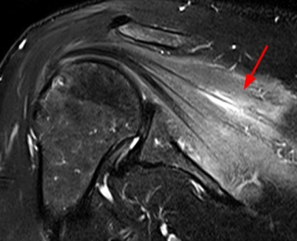 Невропатия локтевого нерва