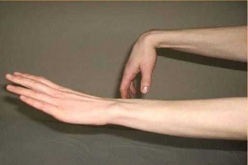 Кисть нормальная и с нейропатией лучевого нерва