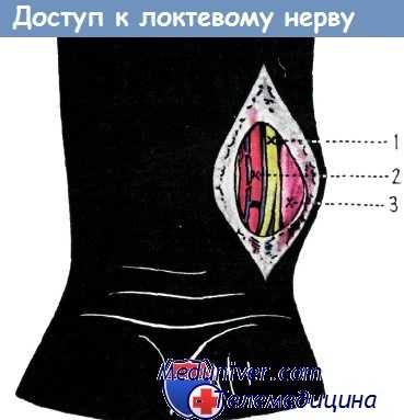 Доступ к локтевому нерву