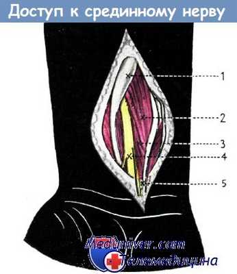 Доступ к срединному нерву