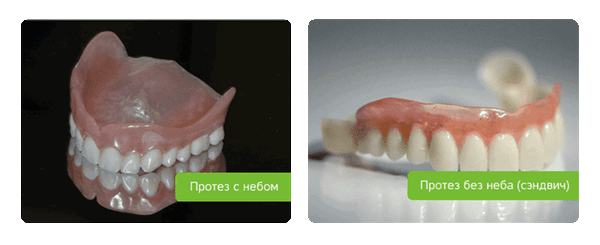 протезы без неба и с небом